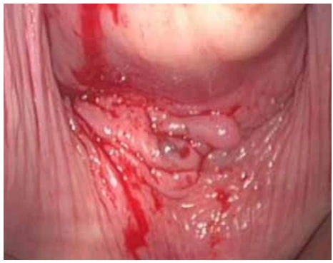 Nodule bleuté du cul de sac vaginal postérieur Nodule bleuté du cul de sac vaginal postérieur