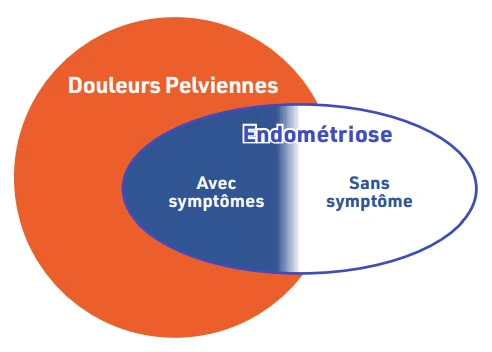 Figure 2 : Modèle de Hurd. Une partie des douleurs pelviennes chroniques ne sont pas considérées comme directement dues à l’endométriose. Figure 2 : Modèle de Hurd. Une partie des douleurs pelviennes chroniques ne sont pas considérées comme directement dues à l’endométriose.