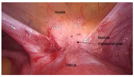 Vue coelioscopique d'un nodule d’endométriose antérieure Vue coelioscopique d'un nodule d’endométriose antérieure