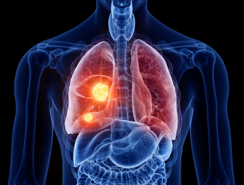 Pneumonies aiguës : toujours plus court