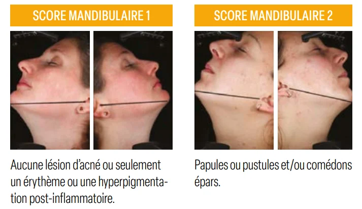 Figure 1 : Échelle d’évaluation de l’acné de la femme AFAST (Adult Female Acne Scoring Tool, d’après Auffret et coll. 2016). Figure 1 : Échelle d’évaluation de l’acné de la femme AFAST (Adult Female Acne Scoring Tool, d’après Auffret et coll. 2016).