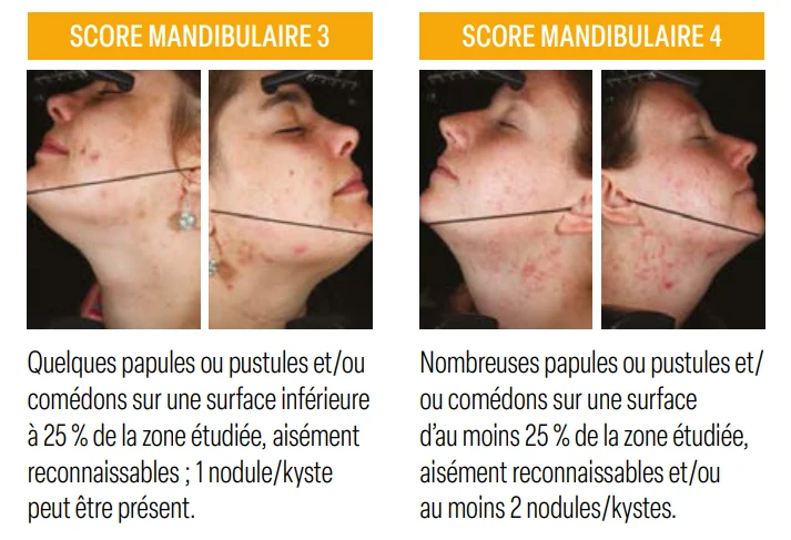 Figure 1 : Échelle d’évaluation de l’acné de la femme AFAST (Adult Female Acne Scoring Tool, d’après Auffret et coll. 2016). Figure 1 : Échelle d’évaluation de l’acné de la femme AFAST (Adult Female Acne Scoring Tool, d’après Auffret et coll. 2016).