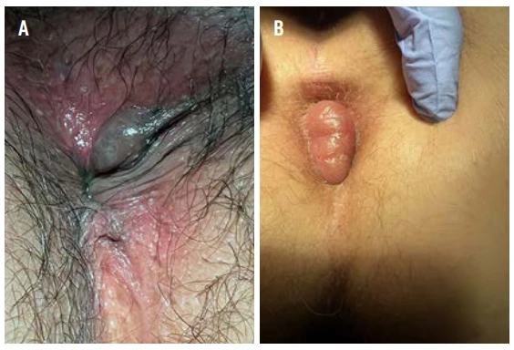 Figure 1 : Thrombose hémorroïdaire externe. (A) Aspect habituel. (B) Formeoedémateuse