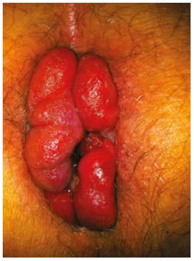 Figure 2 : Prolapsus de thrombose hémorroïdaire interne