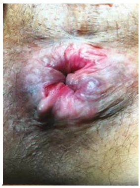 Figure 3 : Fissure anale