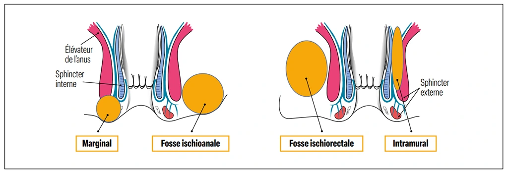 Figure 4 : Localisations des abcès anopérinéaux