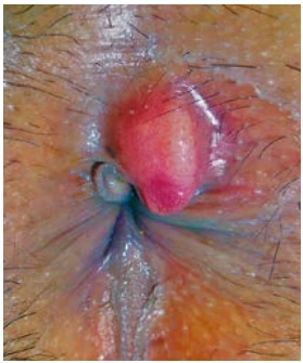 Figure 5 : Abcès de la marge anale