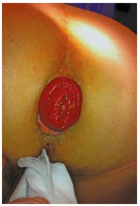 Figure 8 : Prolapsus rectal