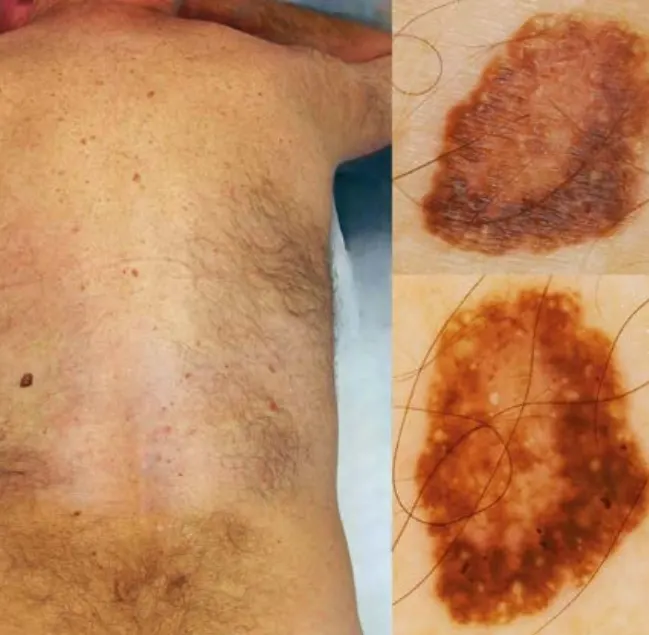 Kératose séborrhéique de diagnostic clinique difficile, mais avec dermoscopie typique, permettant d’éviter une exérèse inutile