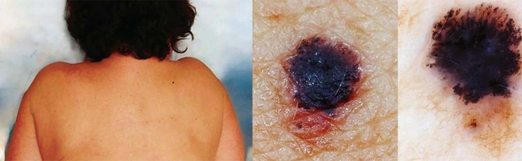 Mélanome de 3 mm de longueur présentant déjà des critères dermoscopiques typiques