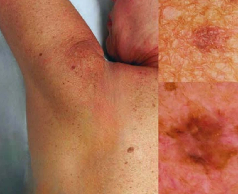 Mélanome de diagnostic possible en dermoscopie mais ne présentant encore aucun signe patent clinique