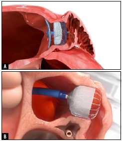 Schéma montrant les deux types de prothèse disponibles en France pour fermer l’auricule gauche. A. Amplatzer (Abbott). B. Watchman (Boston Dynamics). DR.